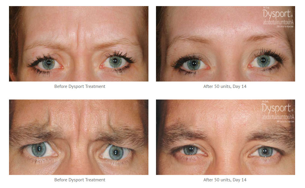 Dysport myfacesurgeon (1)